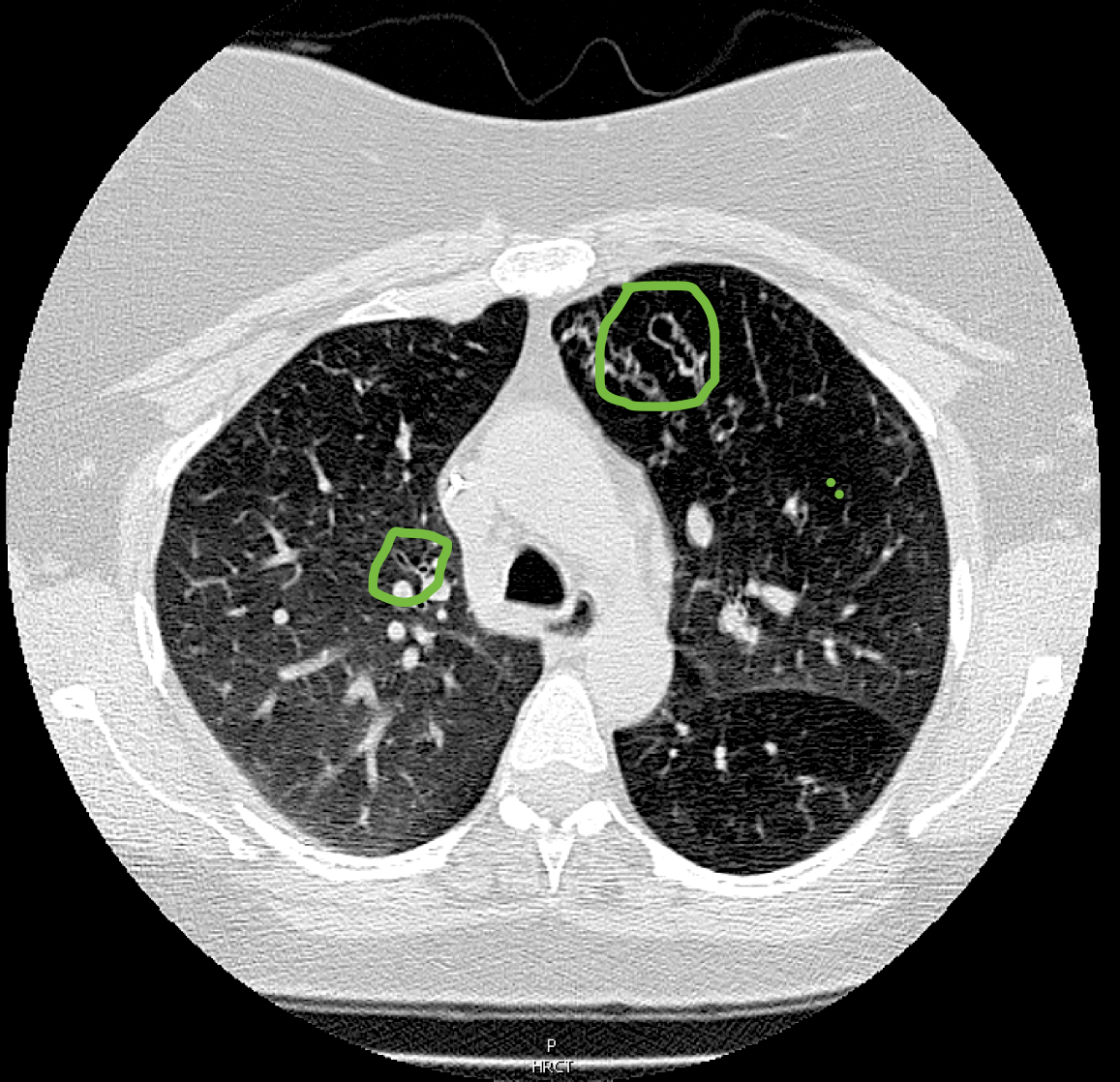 Bronchiectasis, Tuberculosis, and Non-Tuberculosis Mycobacterium (NTM) 2018-2020